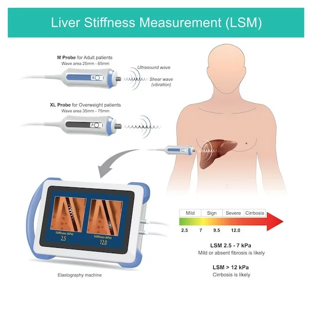 Fibroscan Test – ফাইব্রোস্ক্যান হলো লিভারের ফাইব্রোসিস